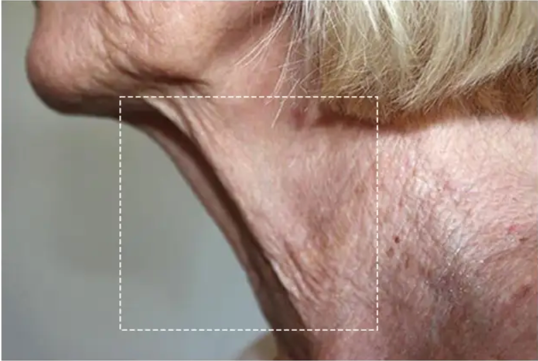 Neck, side view, before