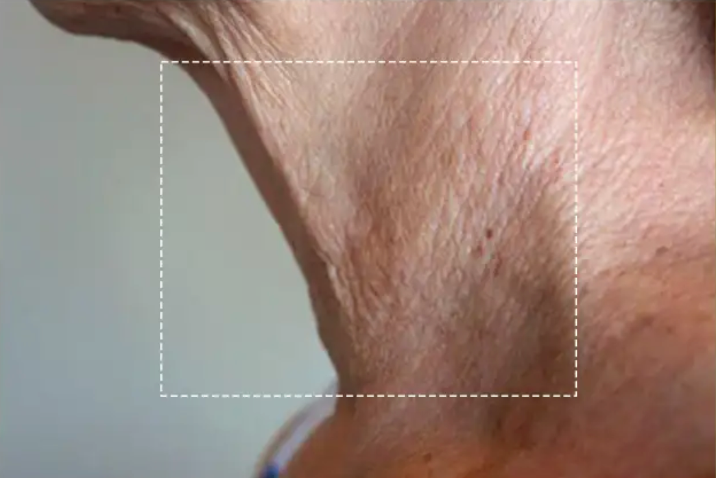 Neck, side view, after