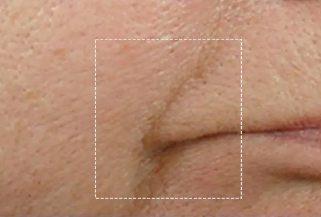 Smile line, before