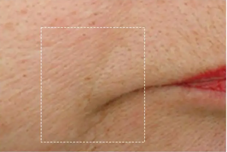 Smile line, after