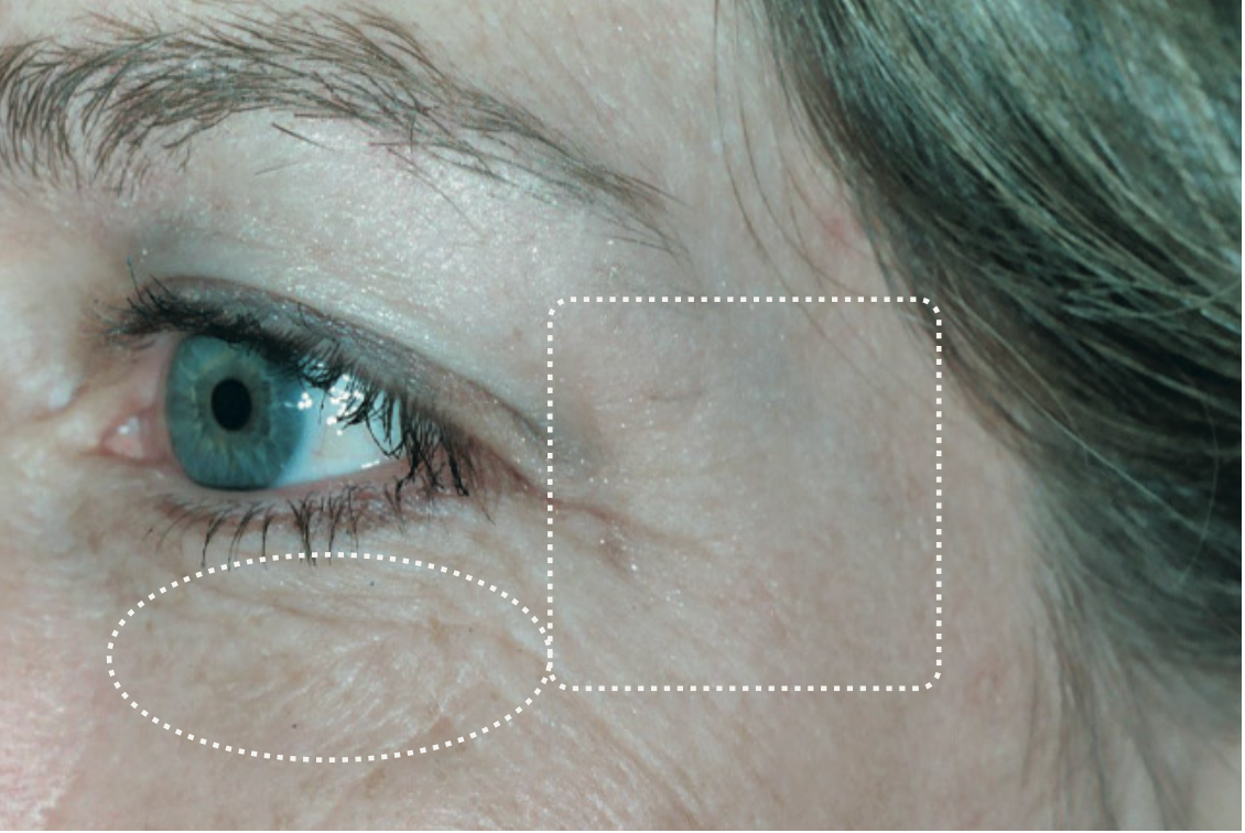 Eye area, before