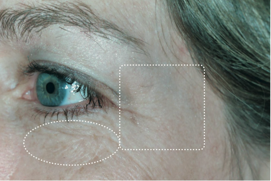 Eye area, before