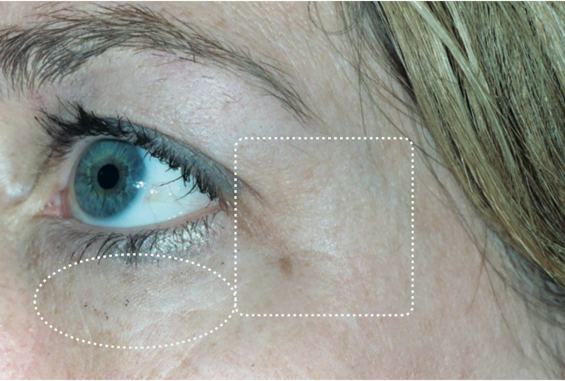 Eye area, after
