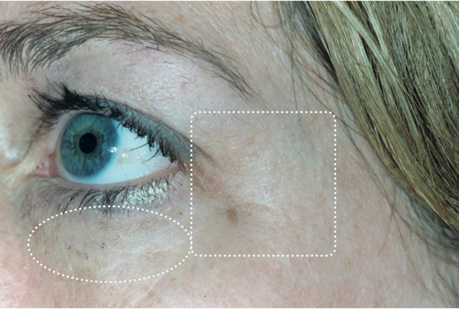 Eye area, after