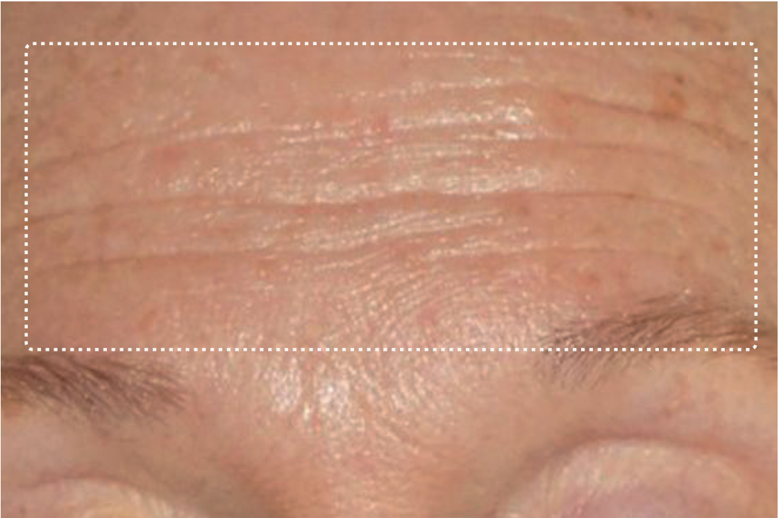 Forehead, before