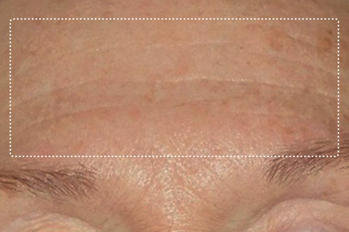 Forehead, after