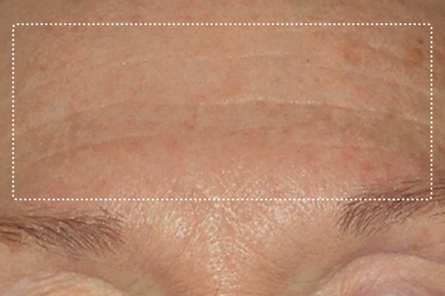 Forehead, after