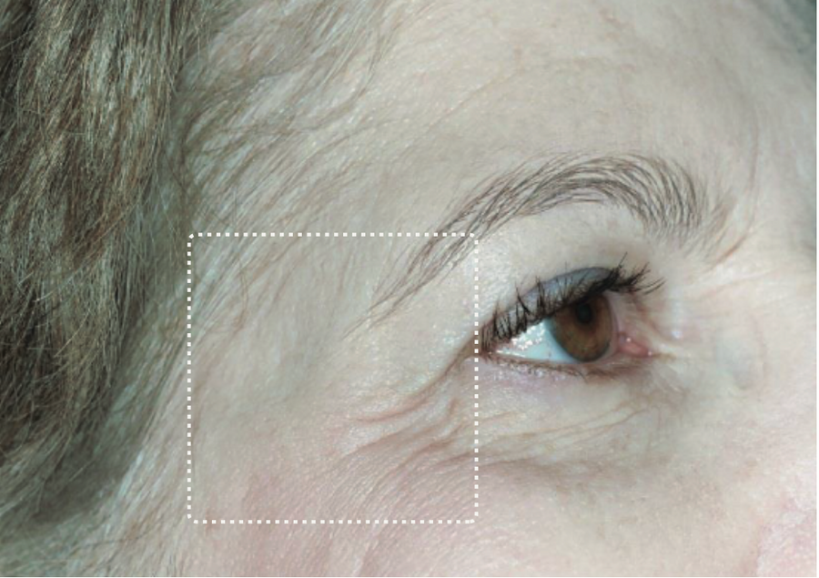Crow's feet, before