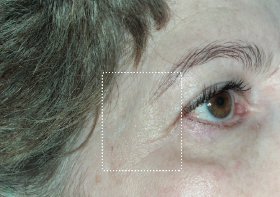 Crow's feet, after