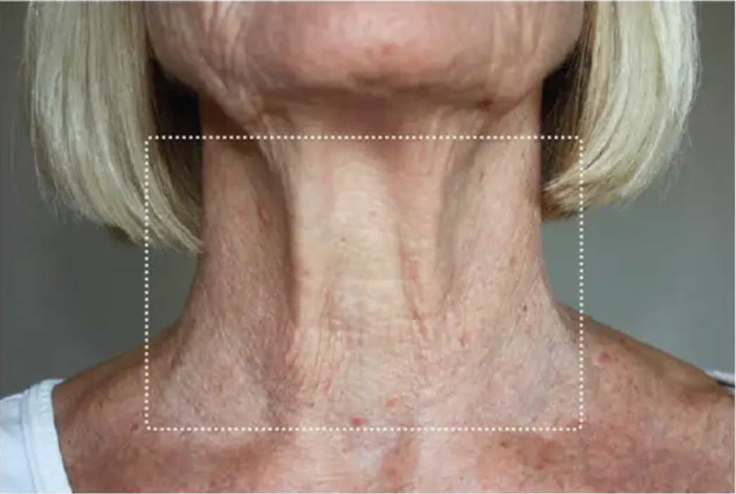 Neck, before