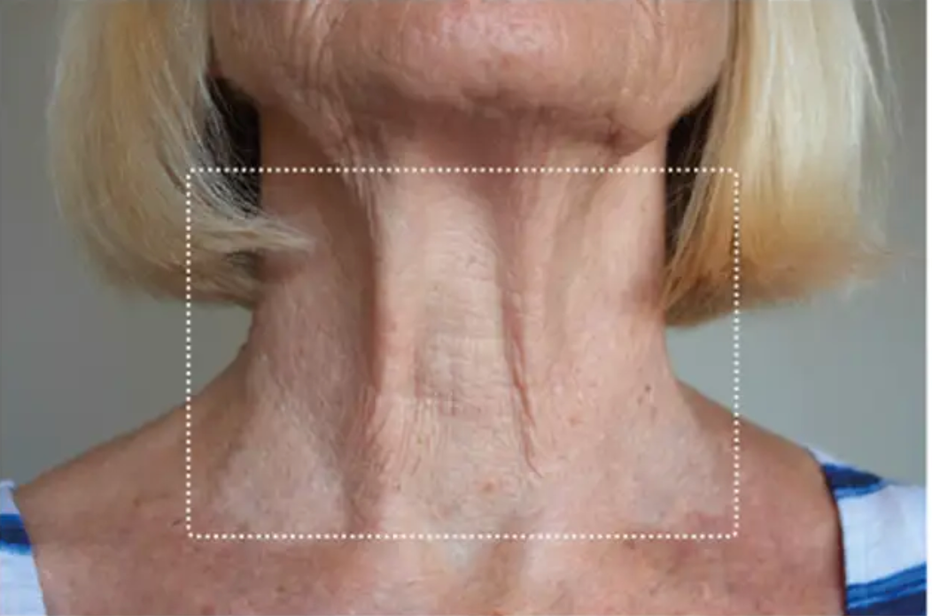Neck, after