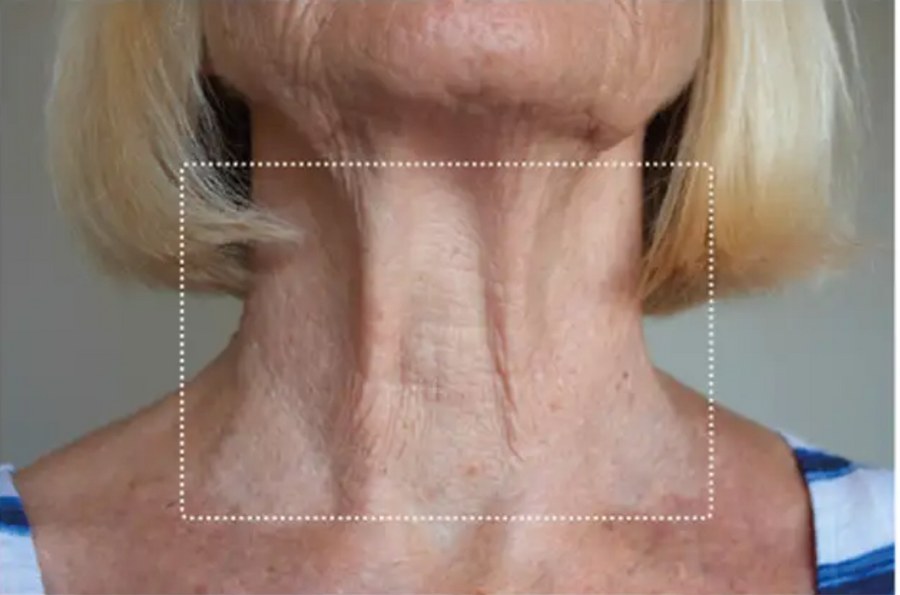 Neck, after